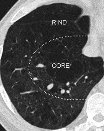 Fig. 3 High-resolution CT image in 68-year-old woman illustrates division of each lung into core and rind regions.