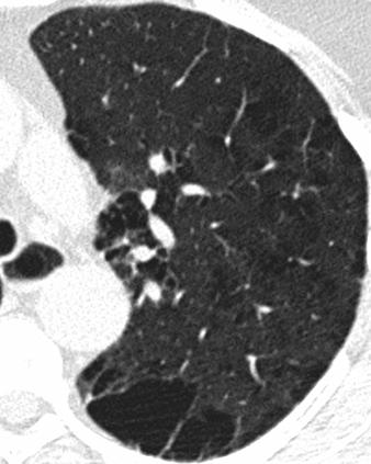 4 High-resolution CT image of 42-year-old man shows islands of normal or near-normal lung adjacent to areas of emphysematous destruction.