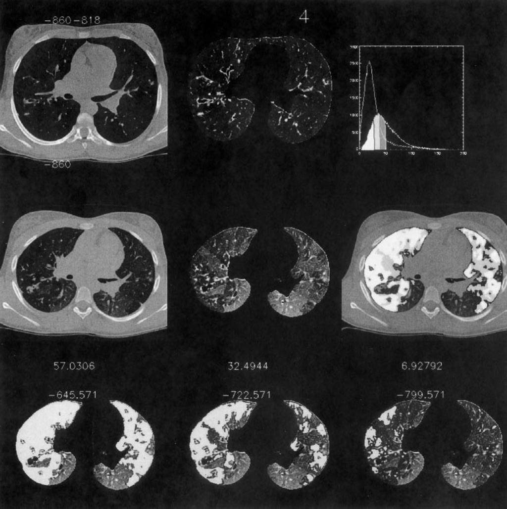 Figure 2. Example of the processing of slice No. 4 in a typical CF case. In the first column of the first row (top), the inspiratory HRCT slice is shown next to the segmented lung at the same level.