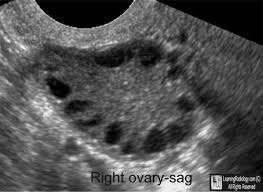 Polycystic Ovary Syndrome A syndrome of excess androgen, chronic anovulation and polycystic ovaries The leading female