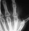 Vol. 15 No. 2, August 2007 Dynamic treatment for proximal phalangeal fracture of the hand 213 Figure 2 Active mobilisation of the hand with the thermoplastic metacarpophalangeal block splint.