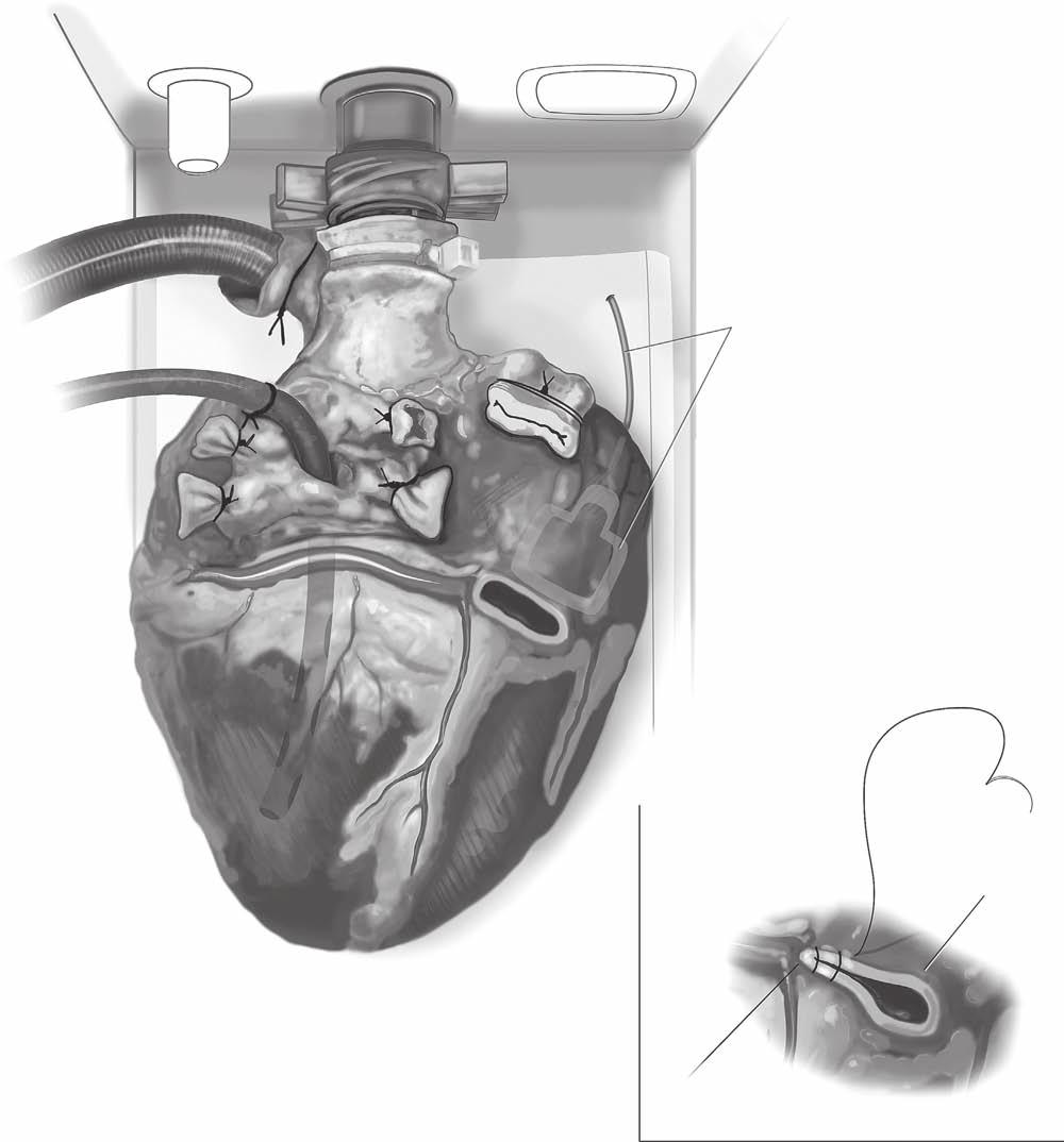 Primary graft failure after heart transplantation 331 RA electrode (under AVgroove) A IVC Figure 9 (A) LV vent placement.