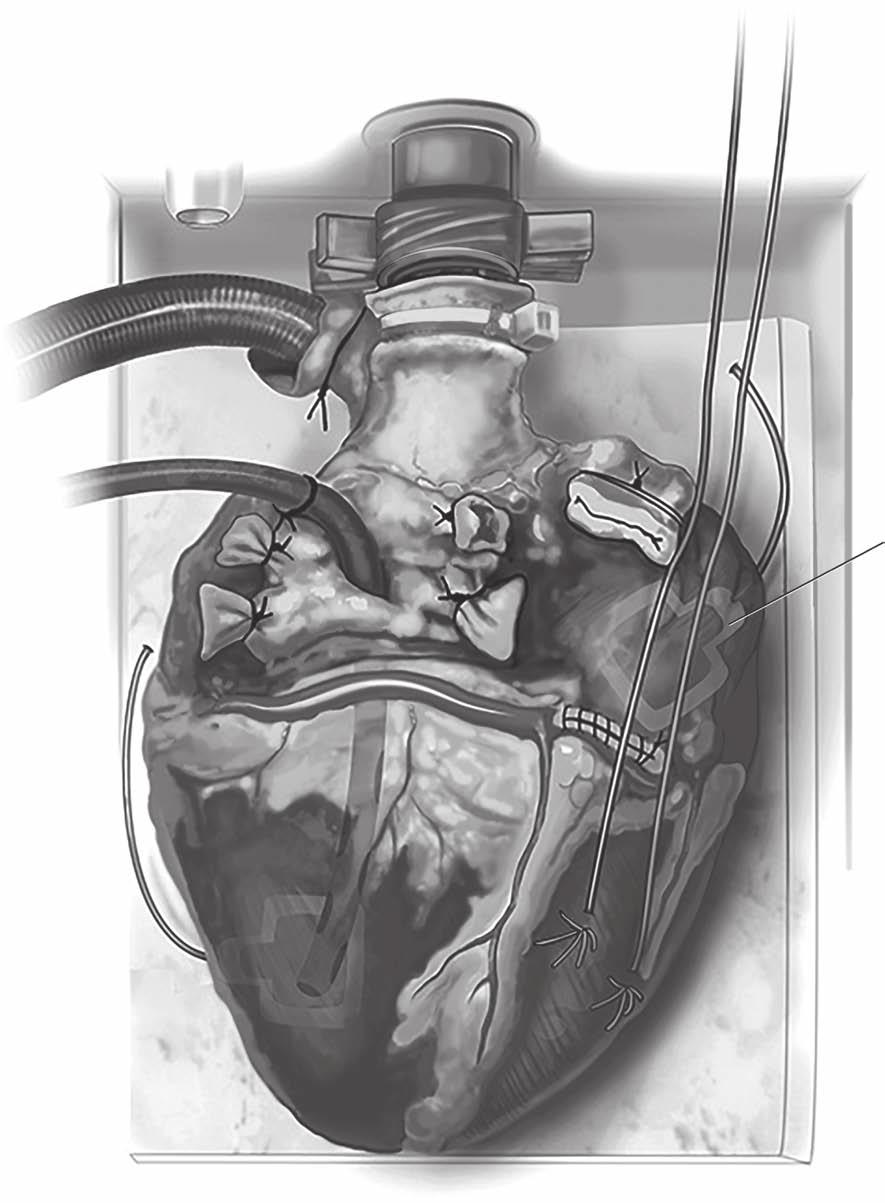 Primary graft failure after heart transplantation 333 Defibrillator pad Figure 11 Adjust