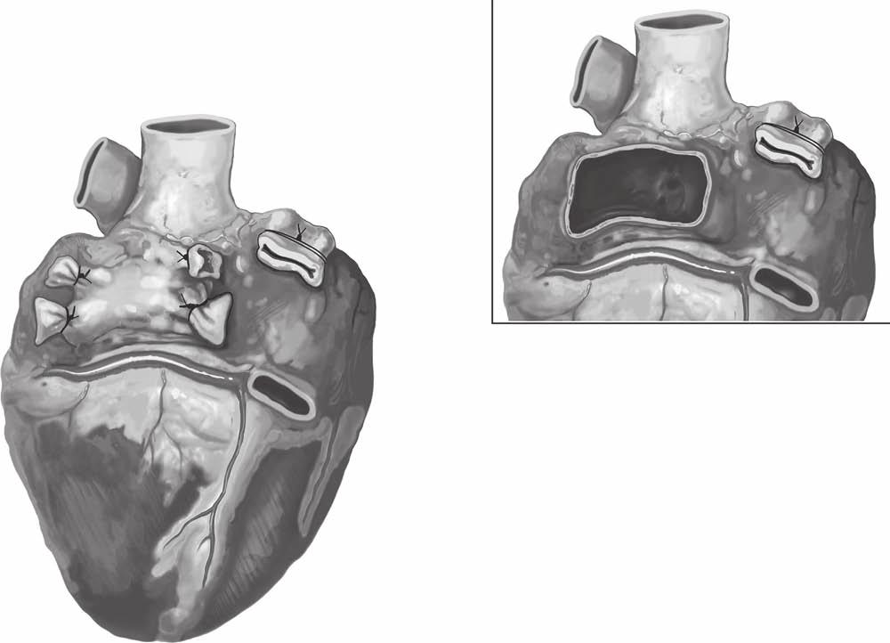 Primary graft failure after heart transplantation 325 B A Figure 3 The donor heart is harvested using the cold cardioplegia following the retrieval team s standard procedures.