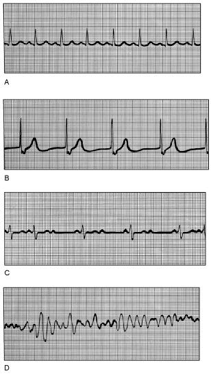 Figure 18.3 Using Figure 18.3, match the following: 54) Ventricular fibrillation.