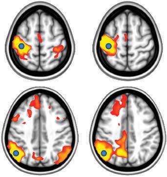 Task-evoked functional MRI (fmri) was performed during bilateral finger tapping. Functional connectivity MRI (fcmri) was performed using a seed in the left sensorimotor cortex (blue circle).