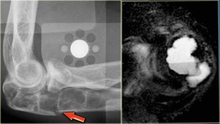 Multiple well-defined osteolytic lesions were found on a follow up CT scan. The differential diagnosis included metastases and Brown tumors in hyperparathyroidism. Biopsy revealed Brown tumor.
