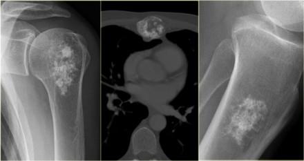 Chondrosarcoma (2) The differential diagnosis on the plain radiographs in all these three cases is enchondroma.