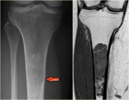 Chondrosarcoma (4) On the left a chondrosarcoma in the proximal tibia diaphysis.