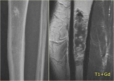 Low grade chondrosarcoma: Bone scintigraphy (left) and fast dynamic contrast enhanced MR (right) Chondrosarcoma (6) On the left a patient with a calcified lesion in the proximal diaphysis of the