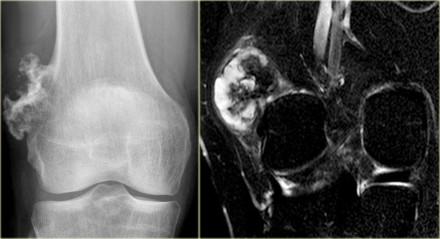 Chondrosarcoma (9) On the left a patient with a broad-based osteochondroma with extension of the cortical bone into the stalk of the lesion.
