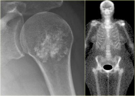 The differential diagnosis is enchondroma or low grade chondrosarcoma. The CT shows the calcifications with subtle endosteal thinning of the cortical bone (arrows).