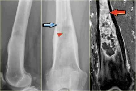 This is, together with the diameter of the lesion in favor of the diagnosis chondrosarcoma. Chondrosarcoma (15) Here a lytic ill-defined lesion in the distal diaphysis of the femur in an old patient.
