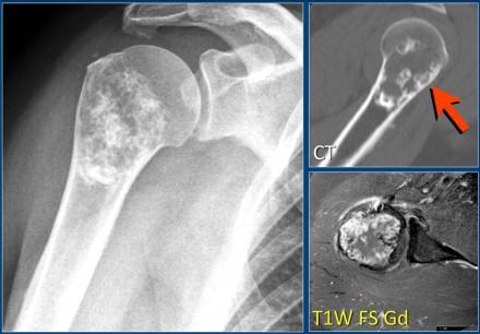 At closer look, there are also faint calcifications present (arrowhead). The T1WI+Gd with fatsat demonstrates the presence of a solid enhancing part and perilesional edema.