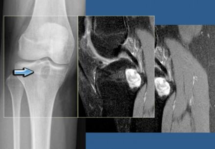 Degenerative cyst versus intraosseus ganglion Here a well-defined lucent lesion in the epiphysis of the proximal tibia in young patient.