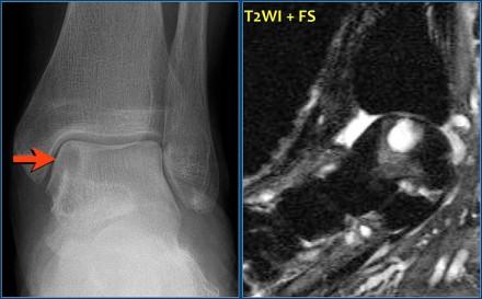 The radiograph shows a well-defined osteolytic lesion in the proximal tibia epiphysis. It is well-defined with high SI on T2WI with FS and there is no reactive edema.