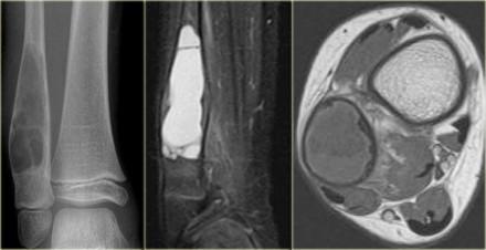 The differential diagnosis based on the CT is: ABC, Osteoblastoma and Tuberculosis (1).