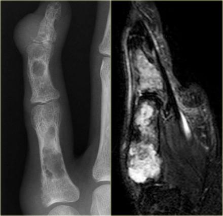 Ollier's disease of the hand Enchondroma (5) On the left a patient with multiple eccentric lytic lesions in the metacarpal bones and phalanges of the left hand.