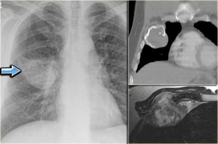 Fibrous dysplasia (3) On the left images of a patient with fibrous dysplasia of the rib with remarkable expansion.