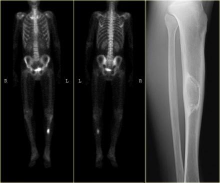Fibrous dysplasia (5) Bone scintigram in 40-year old patient in the tibia shaft.