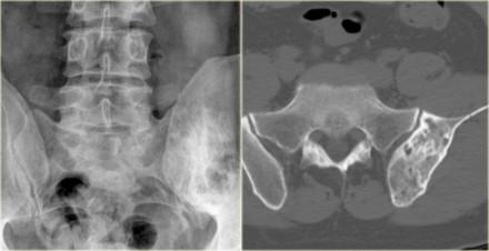 On the far left a well-defined lytic lesion with groundglass appearance in the proximal femur diaphysis, consistent with fibrous dysplasia.