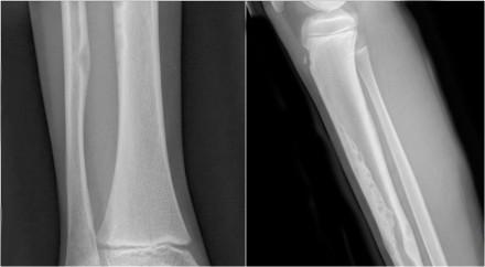 Here a mixed sclerotic-lytic lesion, cortically based in the tibia shaft in a 12-year old boy.