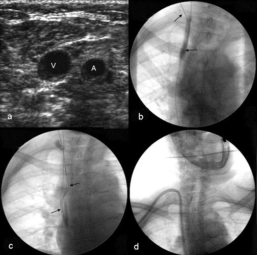 Catheter Case 7 Tunneled Catheter Exchange with Venous Stenosis and a Fibrin Sheath Referral: Catheter with poor flow History: 52 year old female AV graft infection, clotted Multiple catheters in