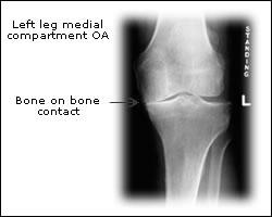 1 4 7 Experimentally Induced Knee Pain Does knee pain alter joint mechanics in a way that may promote osteoarthritis?