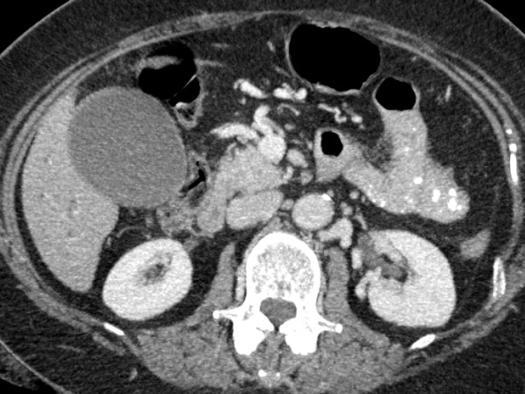 hypoenhancing mass lesion in the pancreatic head/uncinate