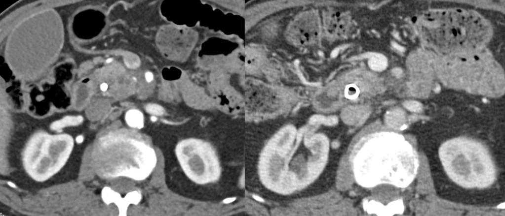 Response Assessment: Post- Chemoradiation a b Figure a- Axial pancreatic phase image shows solid tumor contact with SMA.