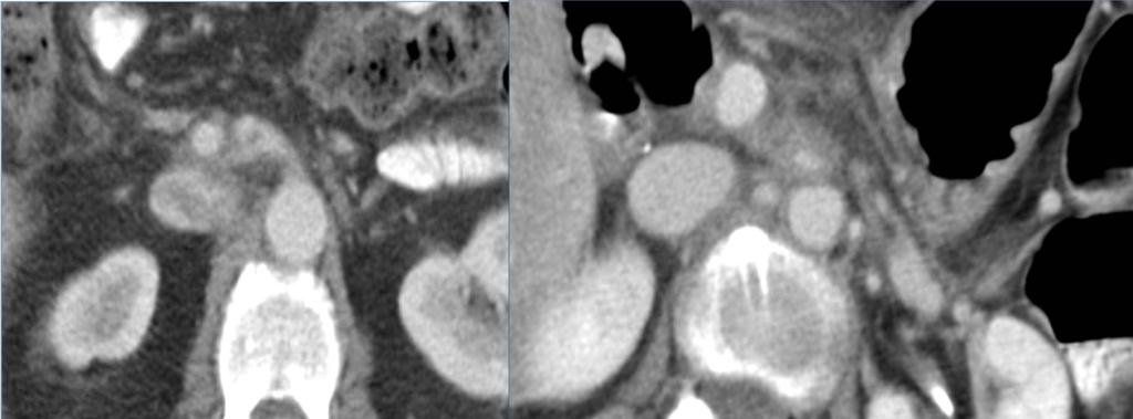 Post-Surgical Imaging Pancreatic surgery carries a high risk for significant morbidity including pancreatic fistula, postoperative abscesses, portal vein or superior mesenteric vein thrombosis,