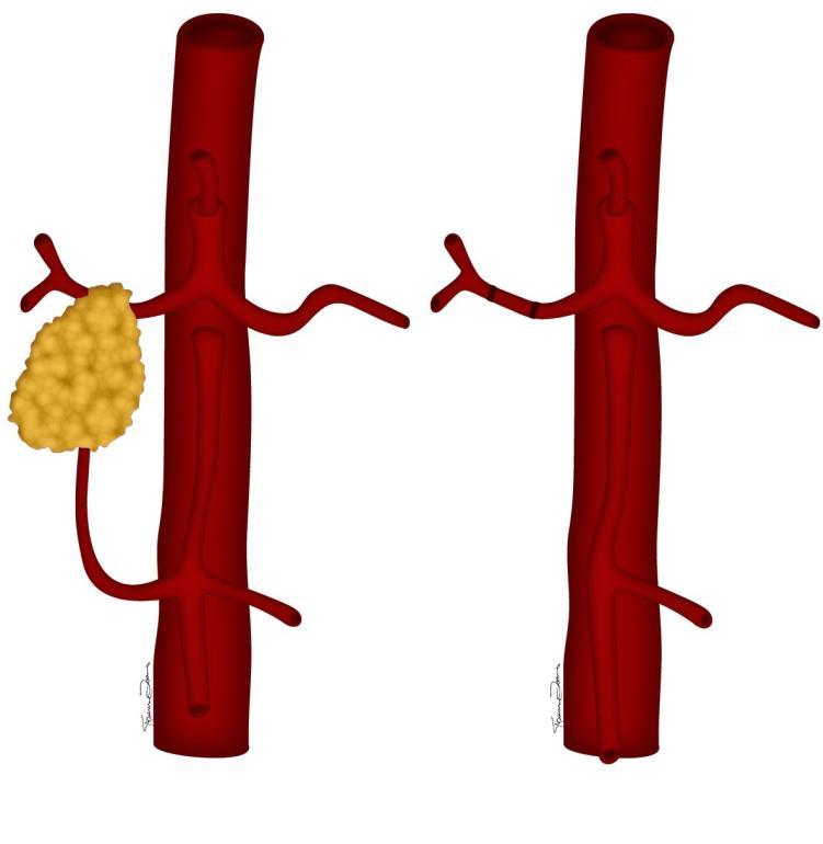 Arterial Reconstruction Techniques Common Hepatic artery (CHA) flow must be preserved to avoid postoperative hepatic ischemia.