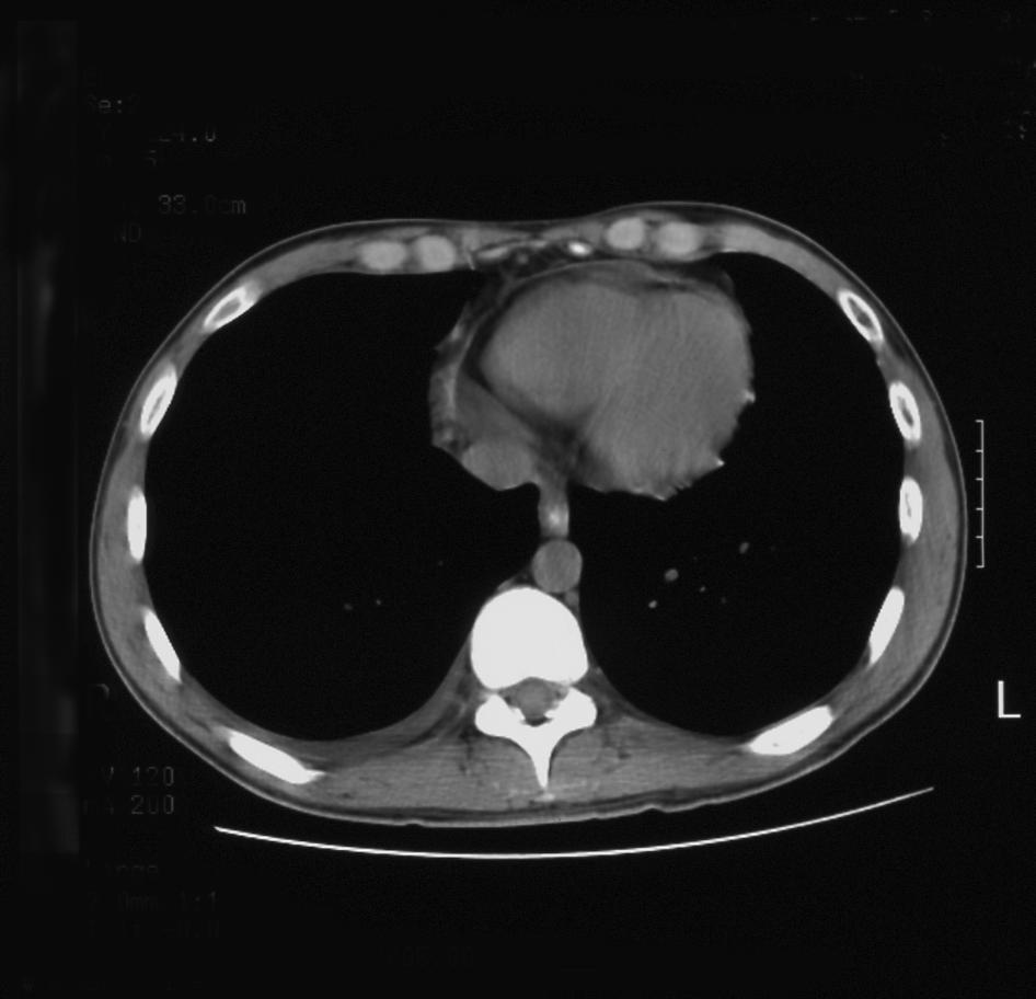 Out Patient: Chest CT Small pericardial