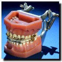 History of Dental Work The First Metal Mouths In the early 1900s orthodontists used gold, platinum, silver,