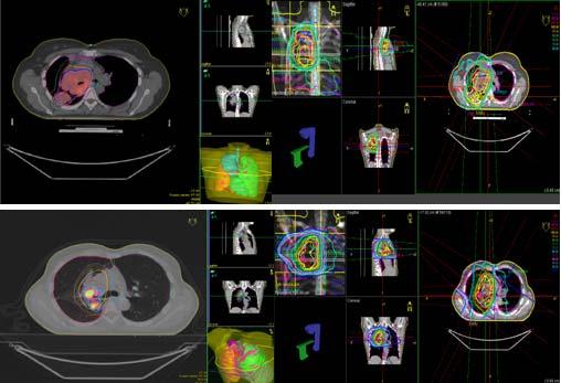 We analysed the case of two pulmonary cancer patients, treated with radical radiotherapy and chemotherapy for non-small cell lung cancer (NSCLL), too advanced for primary surgical treatment.