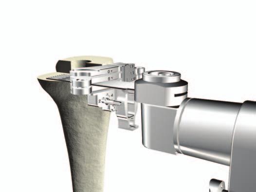 Triathlon TS Knee System Surgical Protocol > Make the appropriate 5mm or 10mm tibial augment resections. > Remove the Revision Tibial Resection Guide from the tibia.