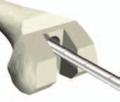 3) A femoral offset can be planned for by reaming an additional 25mm, for a total of 75mm greater than the desired stem length (Stem + 50mm from the joint line to the boss + 25mm Offset).