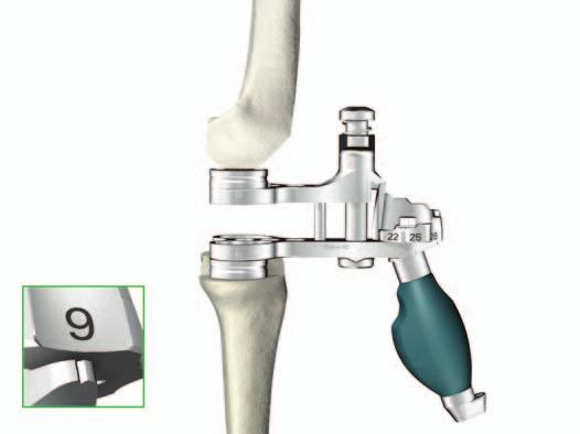 If distal femoral and/or tibial augmentation has been prepared for, assemble the appropriate thickness of Spacer Block Augments to the appropriate sides of the upper and/or lower paddle of the