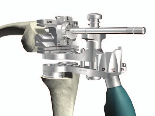 Triathlon TS Knee System Surgical Protocol Assembly for Left Femur Shown Femoral Resections/Offsetting/Flexion Gap Balancing > If distal augments are required, assemble Distal Spacers to the distal