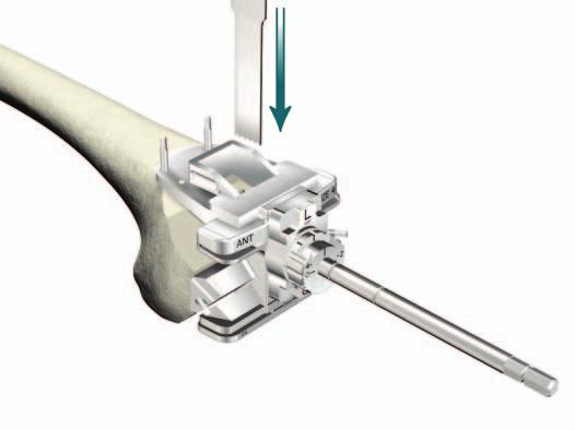 Triathlon TS Knee System Surgical Protocol > Pin the Revision Box Preparation Guide to the bone. > Using a narrow, 15mm - wide 0.