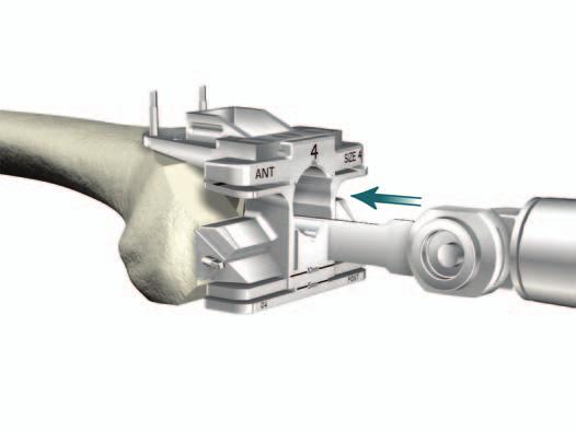 > Remove the Femoral Offset Bushing from the All in One Resection Guide and slide it off the shaft of the IM Reamer. Figure 28 > Using a narrow, 15mm - wide 0.