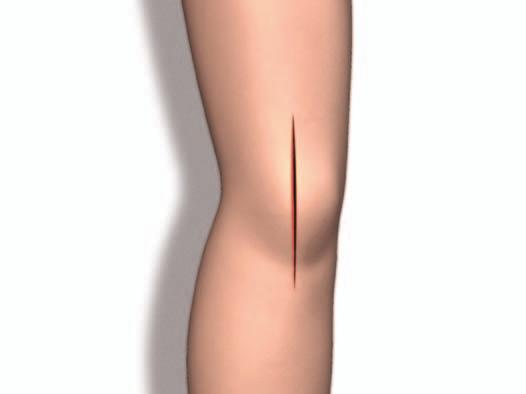 Triathlon TS Knee System Surgical Protocol Exposure > A standard anterior midline incision is utilized. Any previous incision can be used or incorporated to decrease the risk of skin slough.