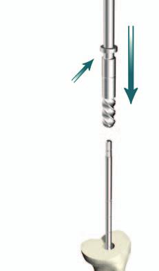 Tibial Preparation Tibial Canal Preparation > Assemble the 8mm Starter Awl to either the T-handle or power unit using the Universal Driver. > Ream the tibial intramedullary canal.