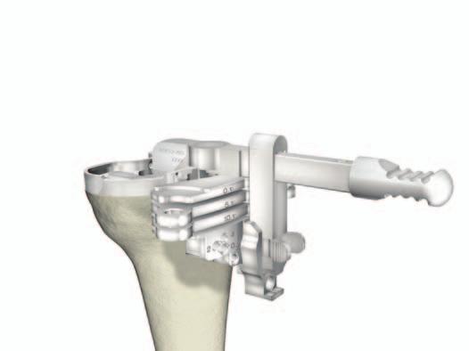 Instrument Bar Universal Tibial Template Tibial Preparation Left 6543-6-700 Right 6543-6-701 Revision Tibial Resection Guides - Slotted 6543-2-703 Tibial Resection Guide Link Figure 7 6543-7-600