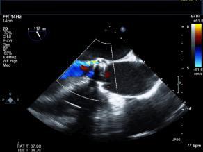 Bicuspid Aortic Valve: TAVR How to Assess