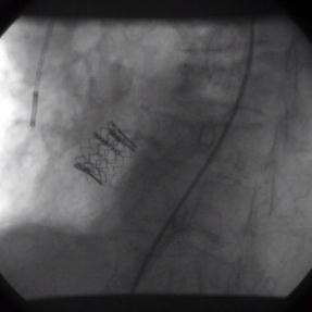Percutaneous Aortic Valve Implantation Via