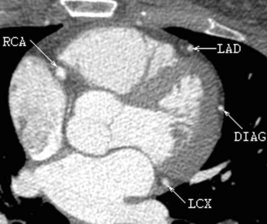 Figure 1. CTA image slice and four major branches: RCA - right coronary artery, LAD - left anterior descending artery, DIAG - its first diagonal branch, LCX - left circumflex artery. Figure 2.