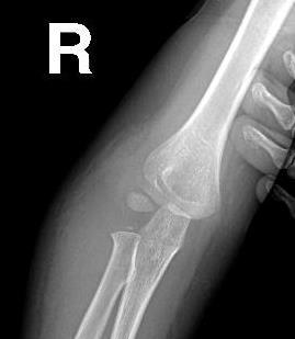 Lateral Humeral Condyle Fractures in Children