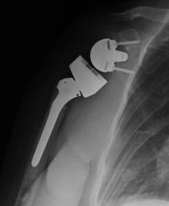 A B Reverse Total Shoulder Arthroplasty Protocol: The intent of this protocol is to provide the physical therapist with a guideline/treatment protocol for the postoperative rehabilitation management