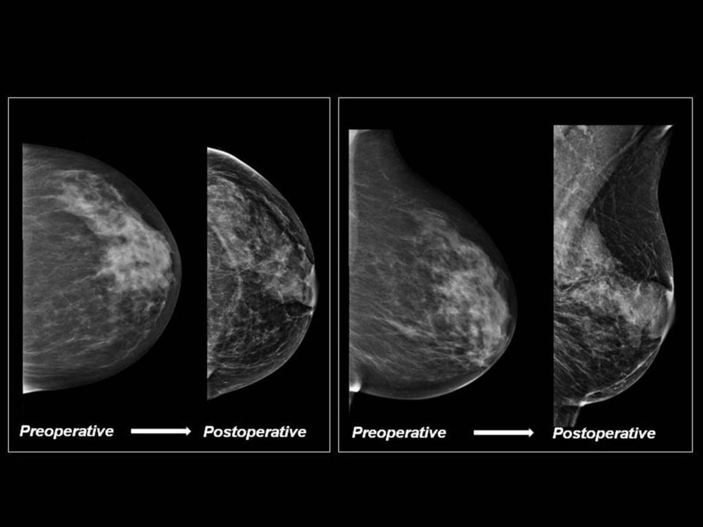 Fig. 4: Normal postoperative findings (Lejour technique). Preoperative and postoperative mammograms are shown for comparison.